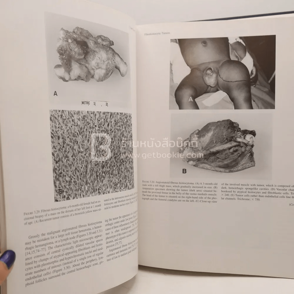 Tumors of the Fetus and Infant - An Atlas